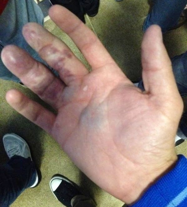 stanton_hand