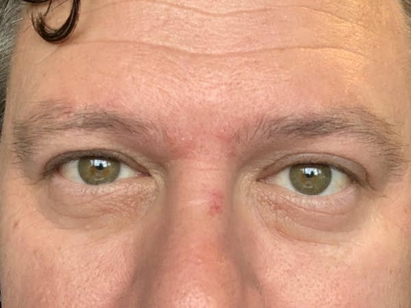 Luke's eyes two days into his mystery ailment