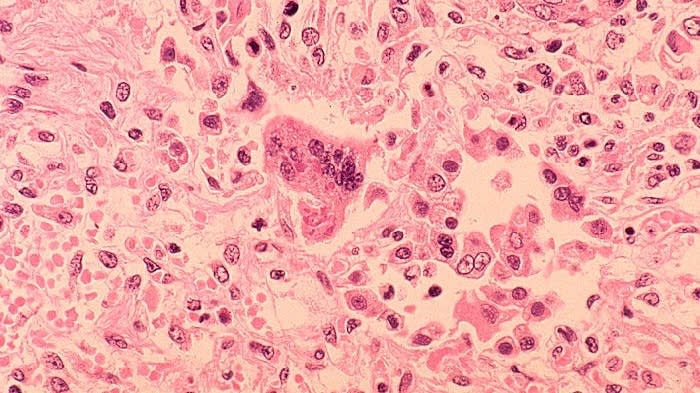 Minnesota Department of Health confirms two measles cases - Vimarsana News