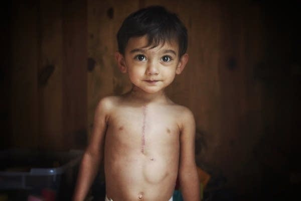 Mom of boy with rare heart condition puts a face on health debate