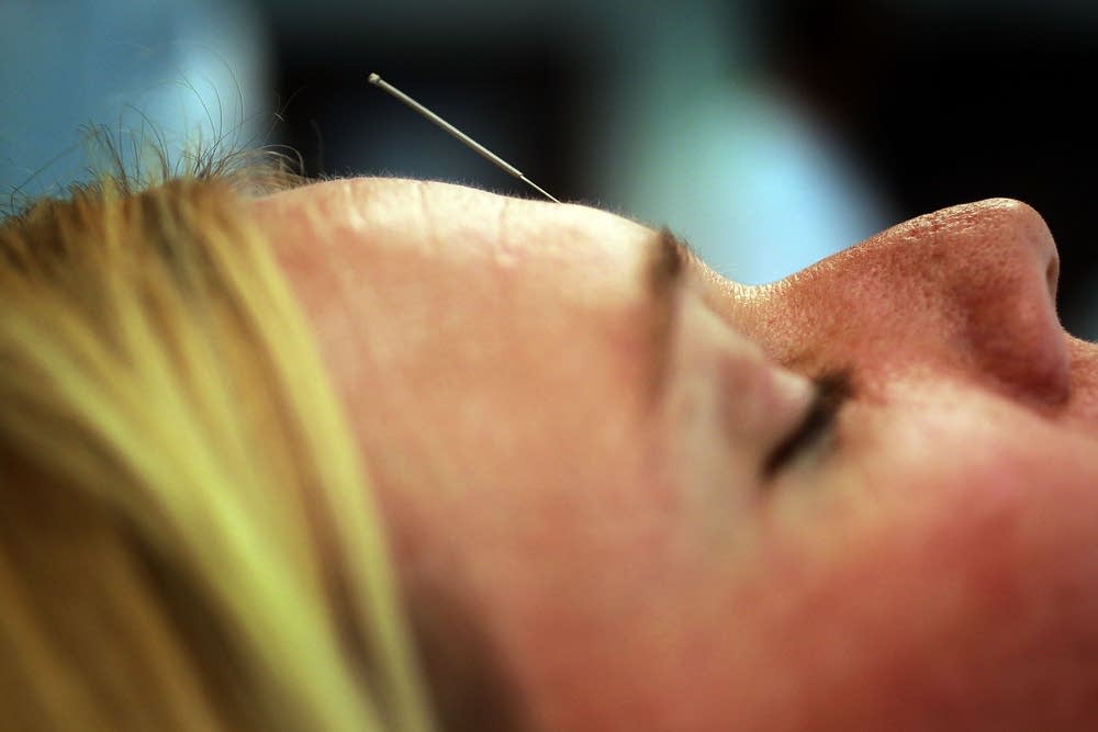 Acupuncture