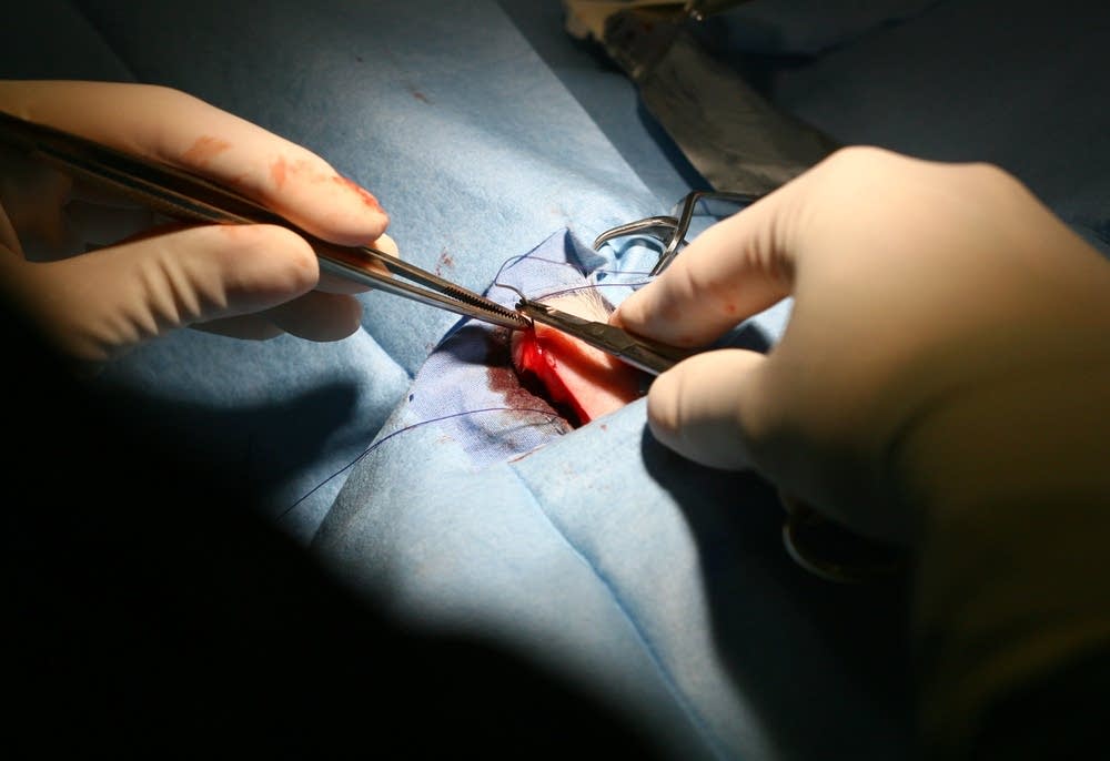 Culbertson sews up an incision