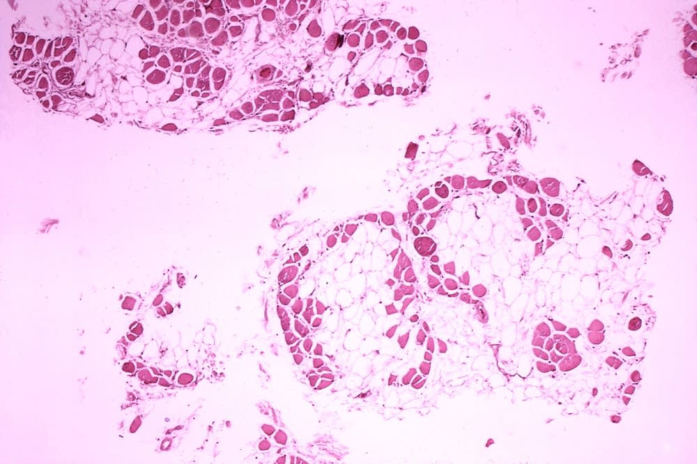Histopathology of gastrocnemius muscle