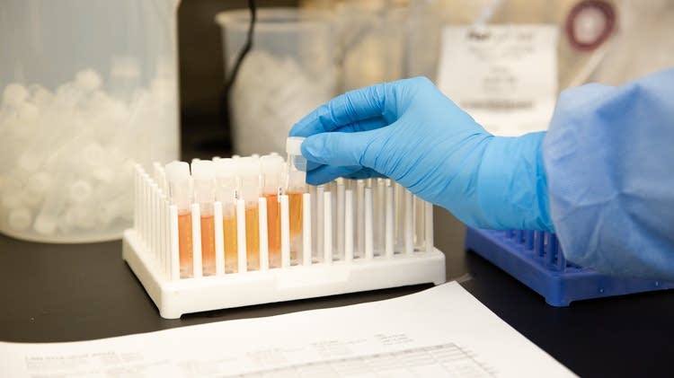 Minnesota confirms 3rd COVID-19 case; person in their 30s, hospitalized