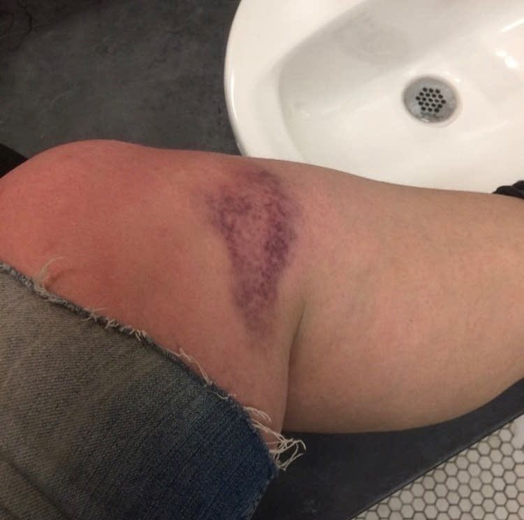Sarah Salisbury shows her bruise from carrying statue between scenes.