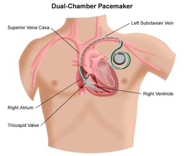 How a pacemaker works