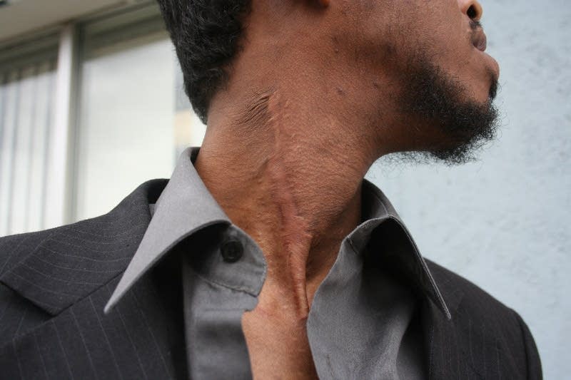 Neck scar