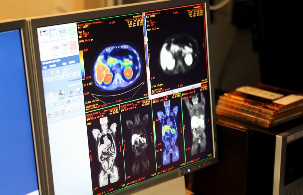 PET scan images