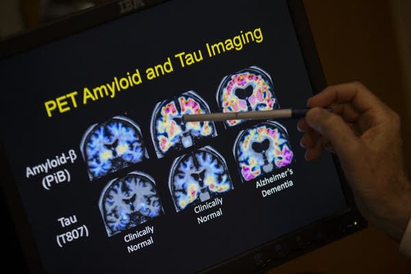 PET scan results that are part of a study on Alzheimer's disease.