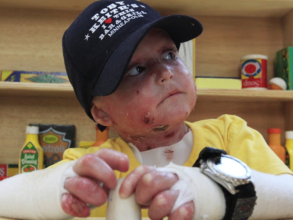 Payton before treatment