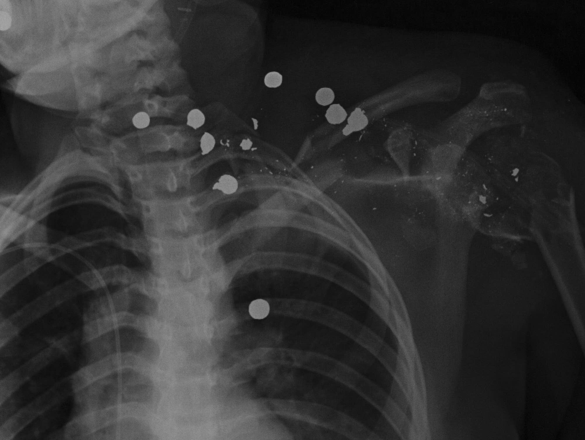 An X-ray taken before Sarah Salazar's emergency shoulder surgery
