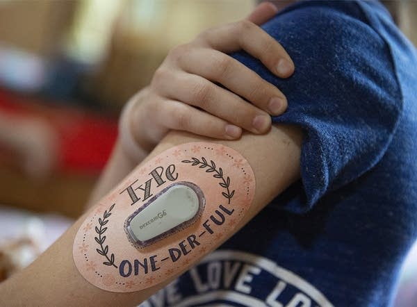 A tape says "Type One-Der-Ful" around a monitor on a girls' upper arm.