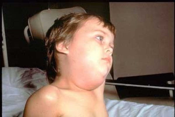 Child with mumps