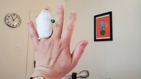 White man's hand with bandaged ring finger and green pin sticking out