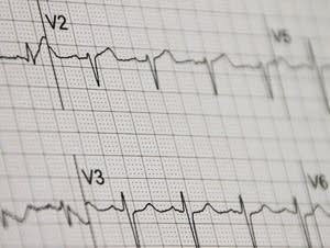 EKG
