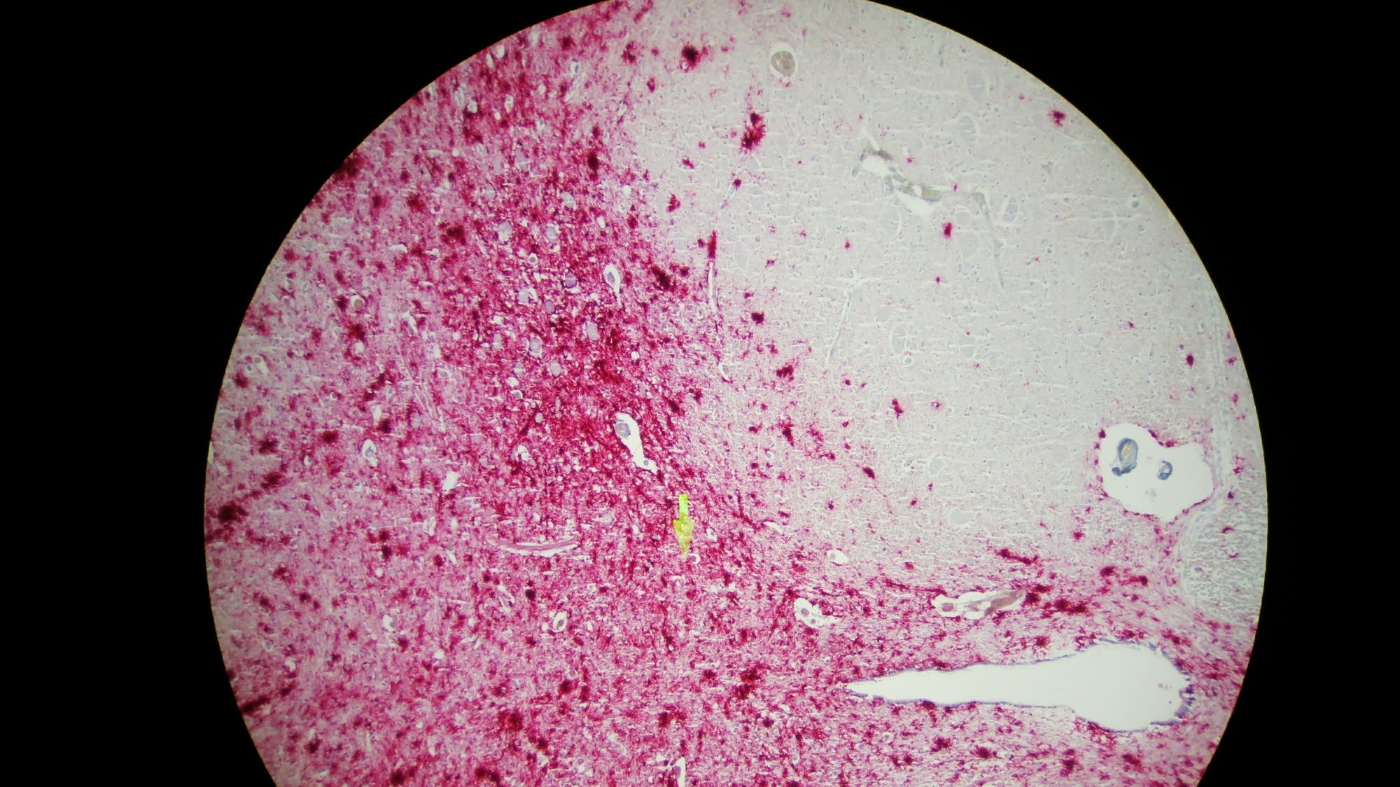 Red dye used in the testing process only sticks to the misfolded proteins