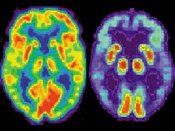 New research into Alzheimer’s disease and dementia 