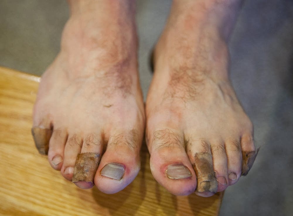 Lee Peyton's blistered and bruised feet