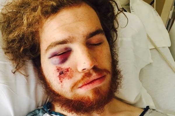Rock attack on Minneapolis cyclist